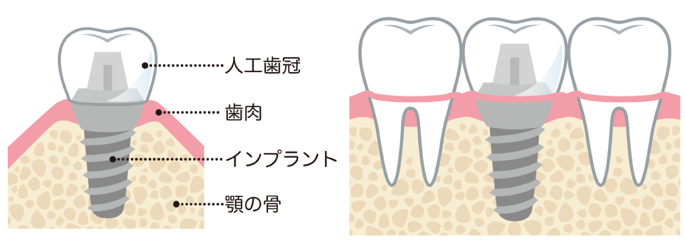 インプラント